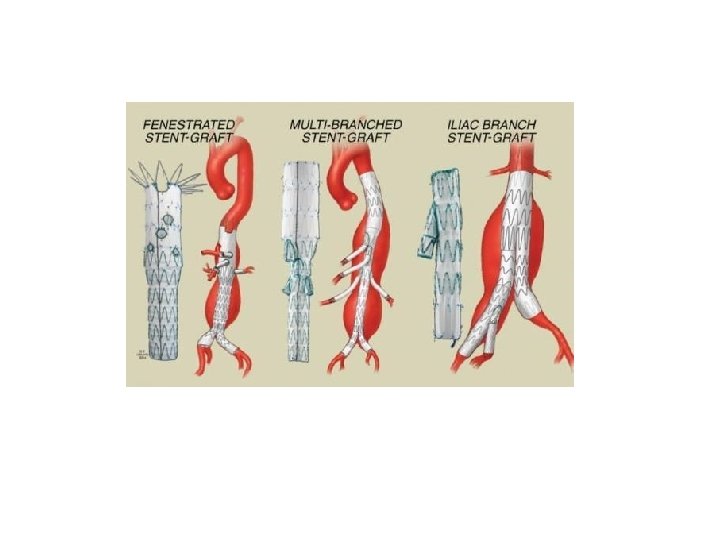 Evoluzione Tecnologica Proglide Usato in combinazione chiude fino al 21 Fr 