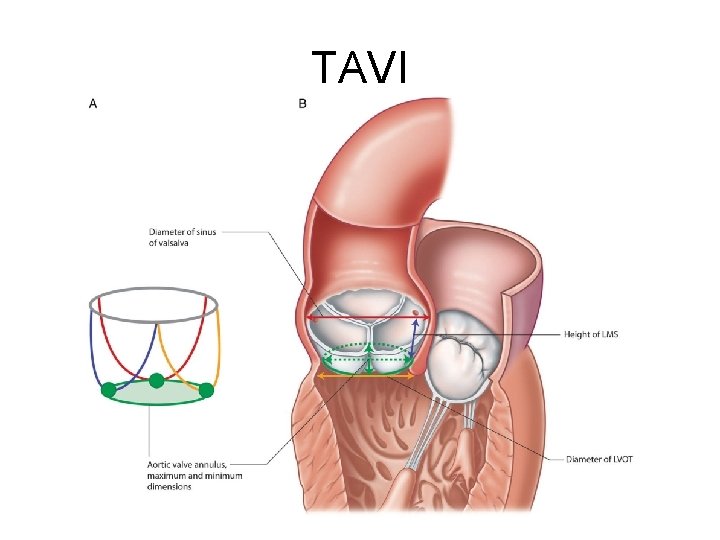 TAVI 