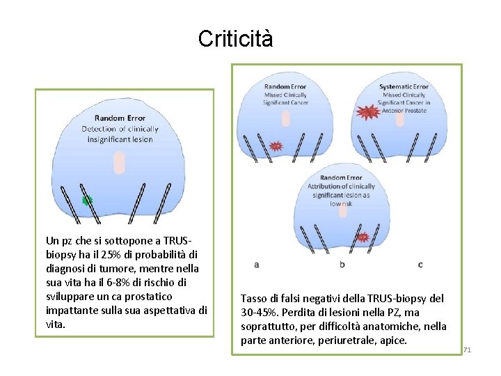 Criticità Un pz che si sottopone a TRUSbiopsy ha il 25% di probabilità di