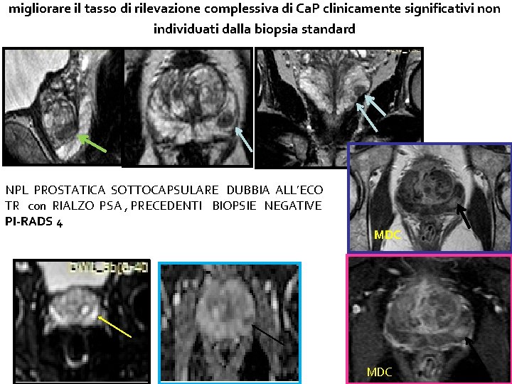 migliorare il tasso di rilevazione complessiva di Ca. P clinicamente significativi non individuati dalla