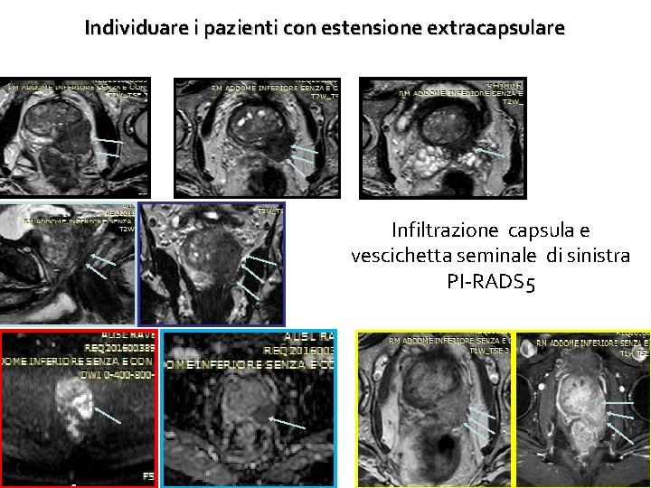 Individuare i pazienti con estensione extracapsulare Infiltrazione capsula e vescichetta seminale di sinistra PI-RADS