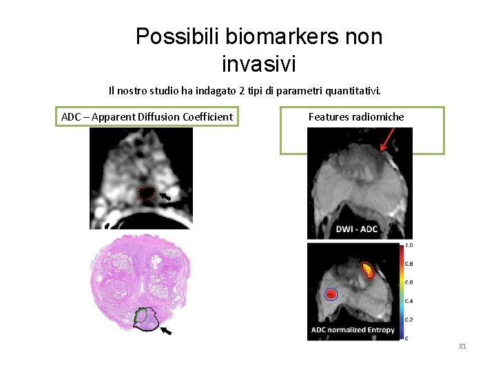 Possibili biomarkers non invasivi Il nostro studio ha indagato 2 tipi di parametri quantitativi.