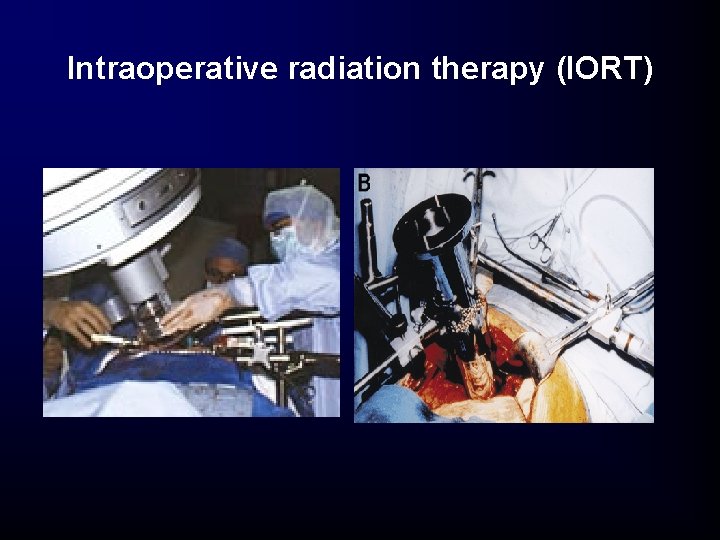 Intraoperative radiation therapy (IORT) Intraoperative radiation therapy (IORT)