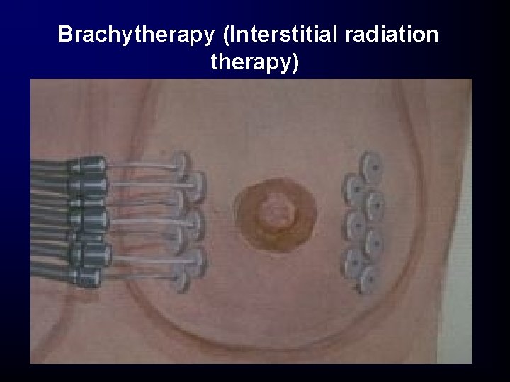Brachytherapy (Interstitial radiation therapy) Brachytherapy (Interstitial radiation therapy)