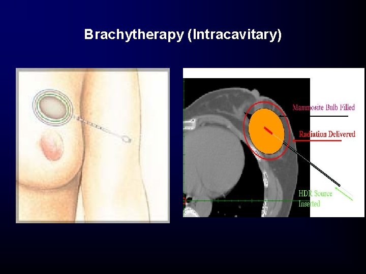 Brachytherapy (Intracavitary) Brachytherapy (Intracavitary)