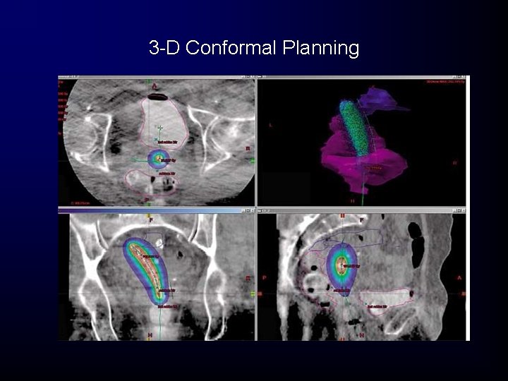 3 -D Conformal Planning 3 -D Conformal Planning