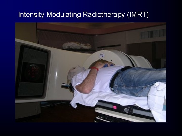 Intensity Modulating Radiotherapy (IMRT) Intensity Modulating Radiotherapy (IMRT)
