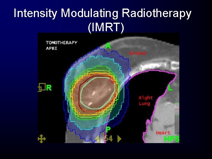 Intensity Modulating Radiotherapy (IMRT) Intensity Modulating Radiotherapy (IMRT)
