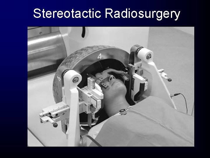 Stereotactic Radiosurgery Stereotactic Radiosurgery