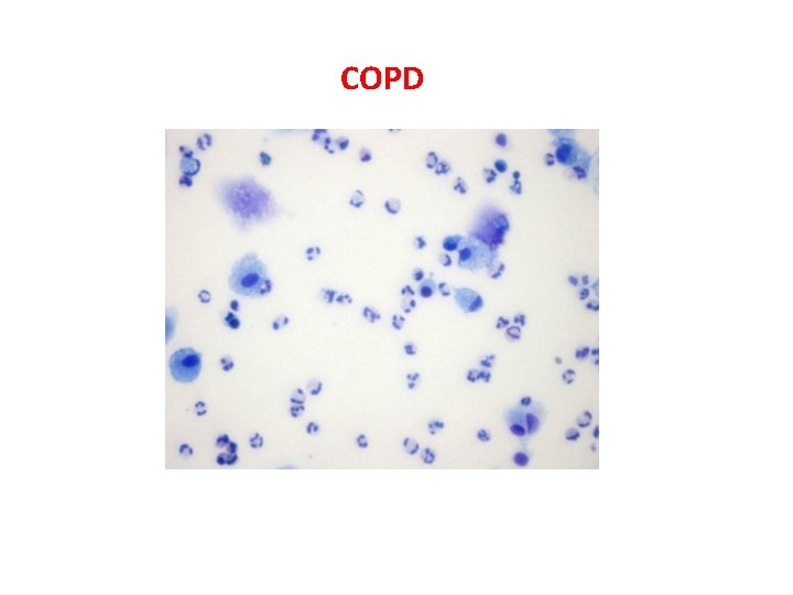 COPD 