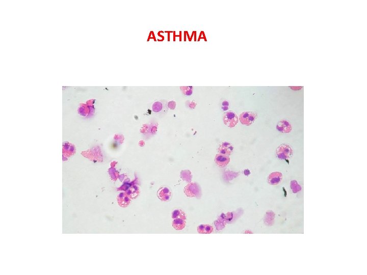 ASTHMA 