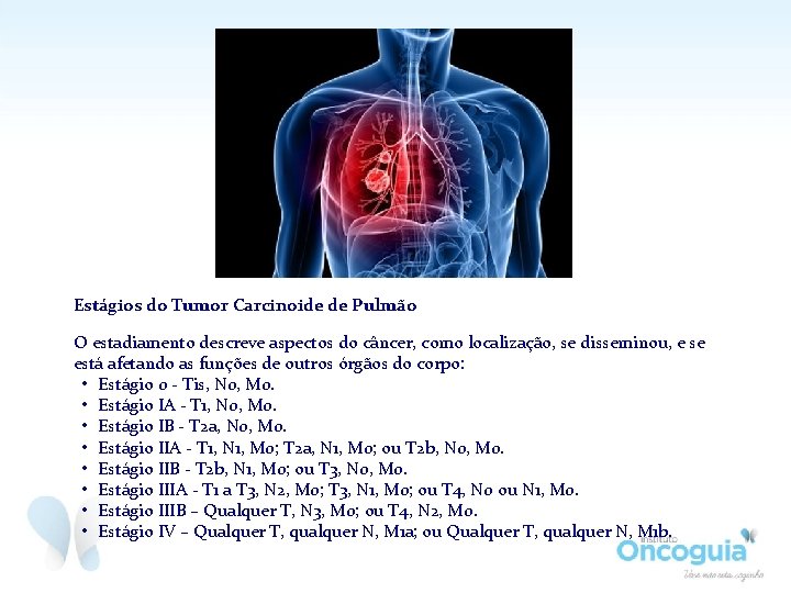 Estágios do Tumor Carcinoide de Pulmão O estadiamento descreve aspectos do câncer, como localização,