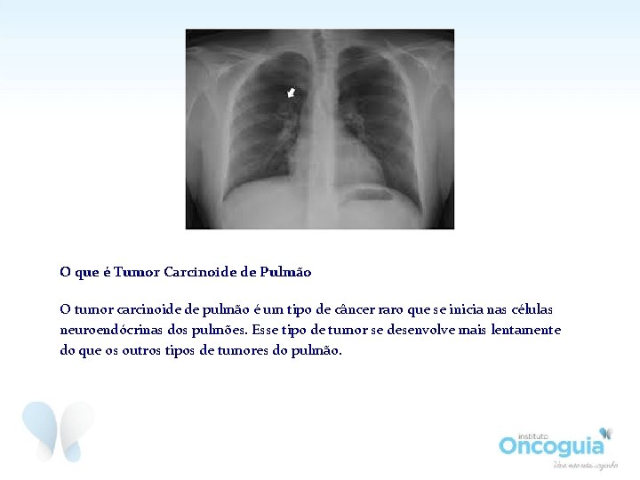 O que é Tumor Carcinoide de Pulmão O tumor carcinoide de pulmão é um