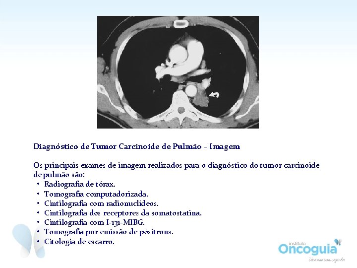 Diagnóstico de Tumor Carcinoide de Pulmão – Imagem Os principais exames de imagem realizados