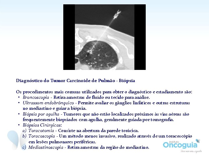 Diagnóstico do Tumor Carcinoide de Pulmão - Biópsia Os procedimentos mais comuns utilizados para