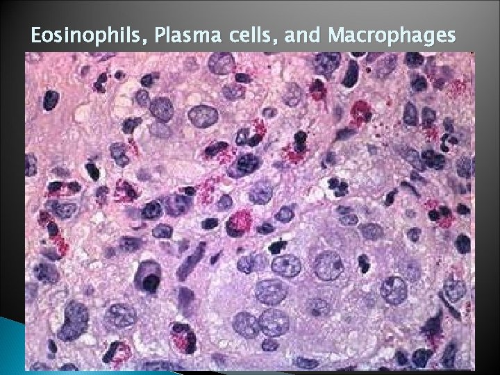 Eosinophils, Plasma cells, and Macrophages 