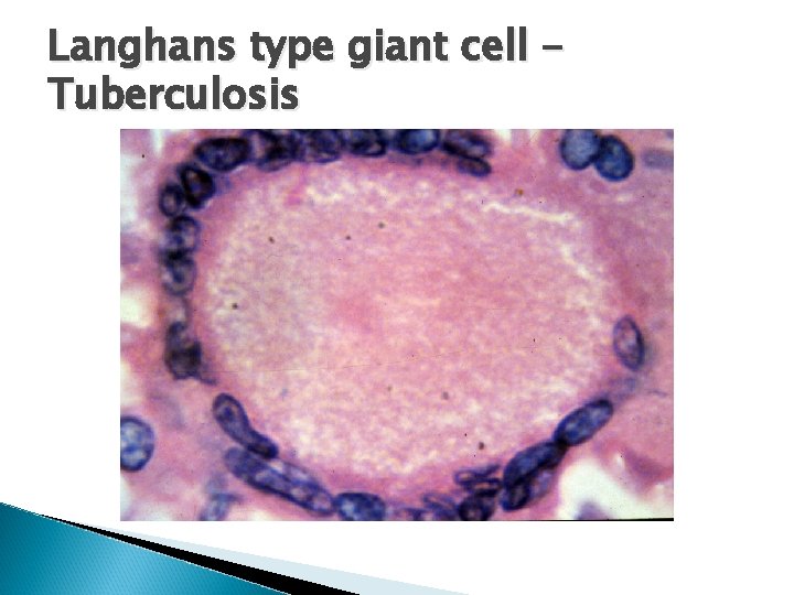 Langhans type giant cell Tuberculosis 