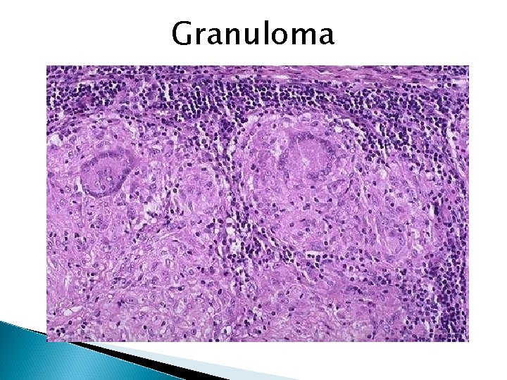 Granuloma 