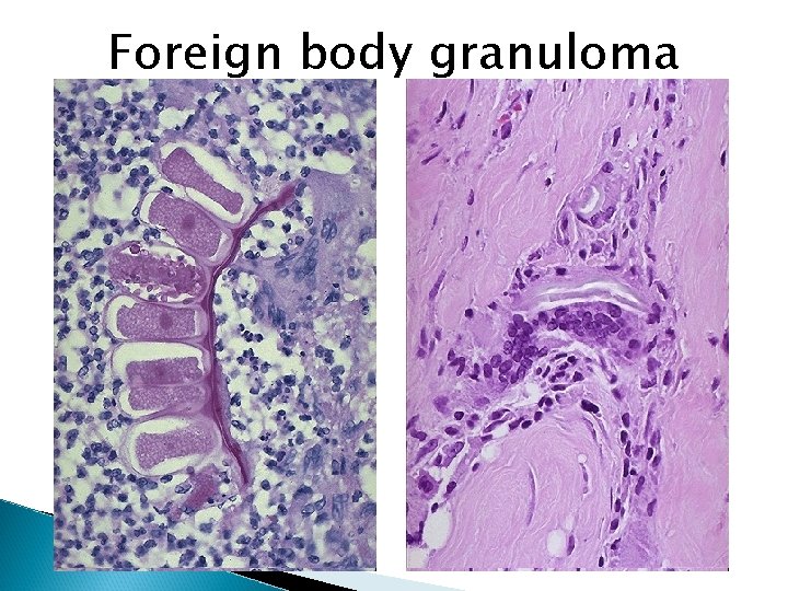 Foreign body granuloma 