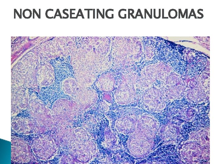 NON CASEATING GRANULOMAS 