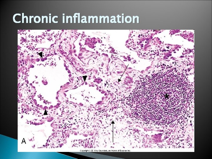 Chronic inflammation 