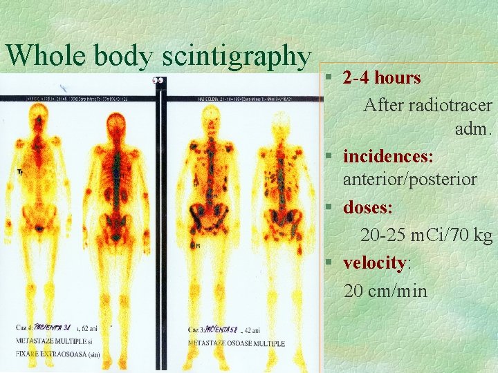 Whole body scintigraphy § 2 -4 hours After radiotracer adm. § incidences: anterior/posterior §