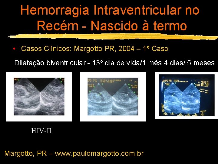 Hemorragia Intraventricular no Recém - Nascido à termo • Casos Clínicos: Margotto PR, 2004