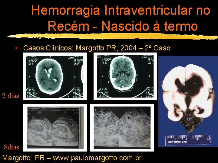 Hemorragia Intraventricular no Recém - Nascido à termo • Casos Clínicos: Margotto PR, 2004