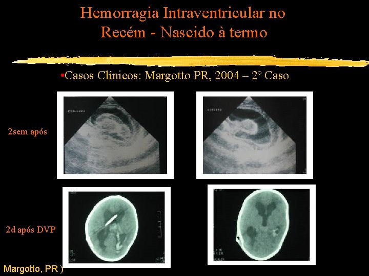 Hemorragia Intraventricular no Recém - Nascido à termo • Casos Clínicos: Margotto PR, 2004