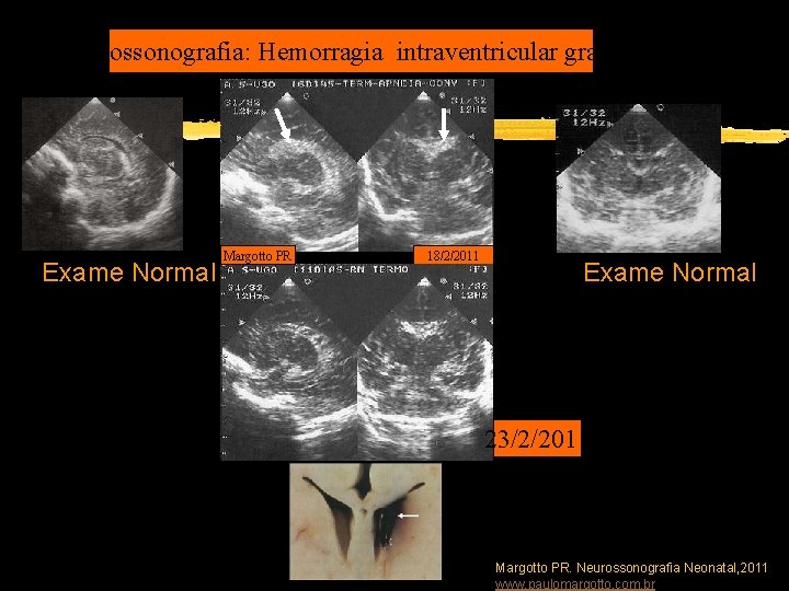 Neurossonografia: Hemorragia intraventricular grau III Exame Normal Margotto PR 18/2/2011 Exame Normal 23/2/2011 Margotto