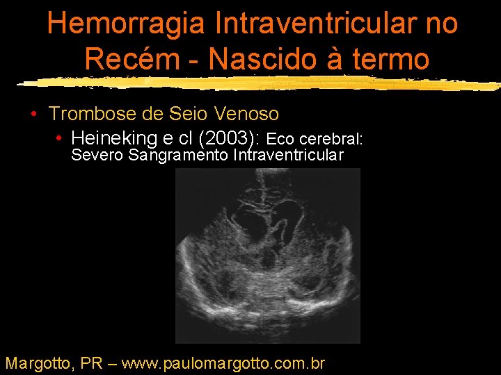 Hemorragia Intraventricular no Recém - Nascido à termo • Trombose de Seio Venoso •