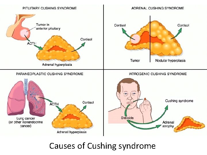 Causes of Cushing syndrome 