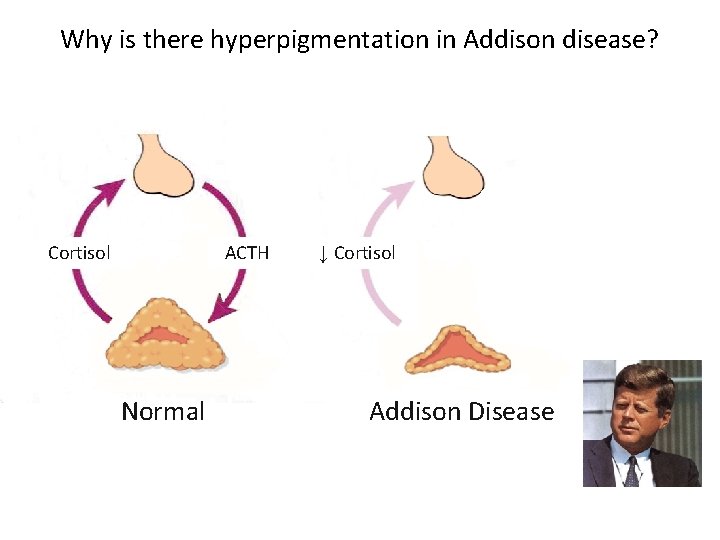 Why is there hyperpigmentation in Addison disease? Cortisol ACTH Normal ↓ Cortisol Addison Disease