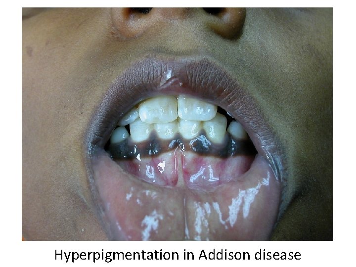 Hyperpigmentation in Addison disease 