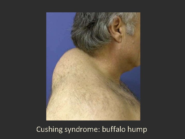 Cushing syndrome: buffalo hump 