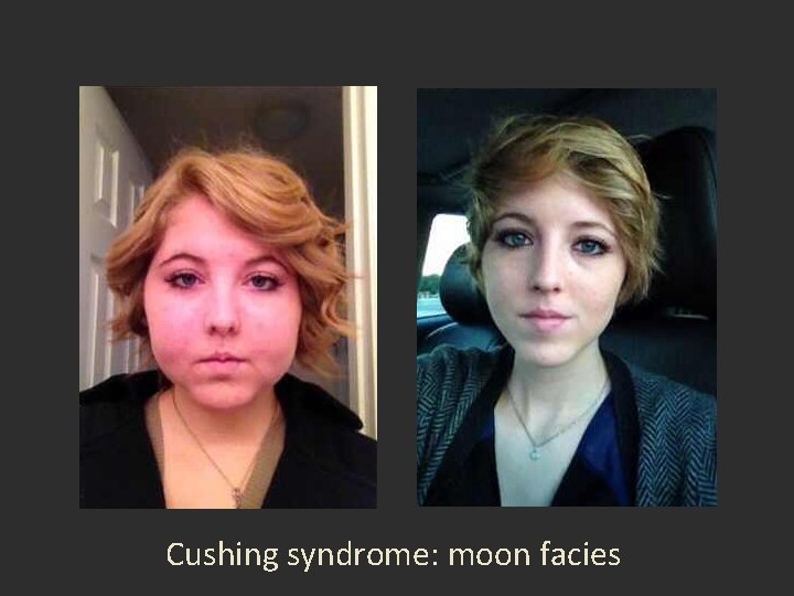 Cushing syndrome: moon facies 