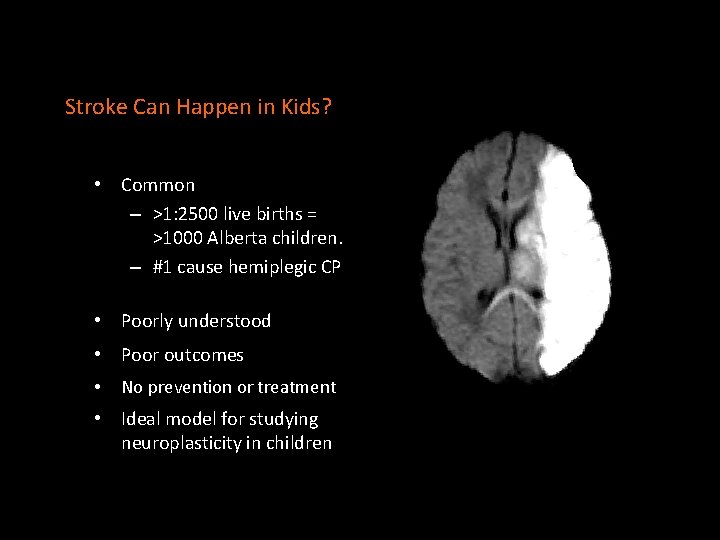 Stroke Can Happen in Kids? • Common – >1: 2500 live births = >1000