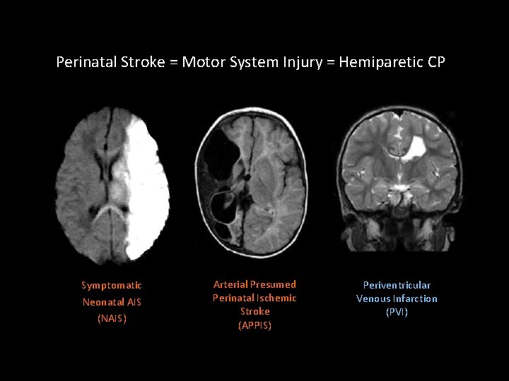 Perinatal Stroke = Motor System Injury = Hemiparetic CP Symptomatic Neonatal AIS (NAIS) Arterial