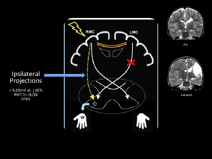 PVI Ipsilateral Projections > 0. 05 m. V at 120% RMT in >5/20 trials