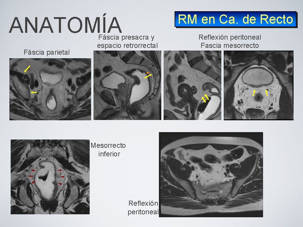 RM en Ca. de Recto ANATOMÍA Fáscia parietal Fáscia presacra y espacio retrorrectal Mesorrecto
