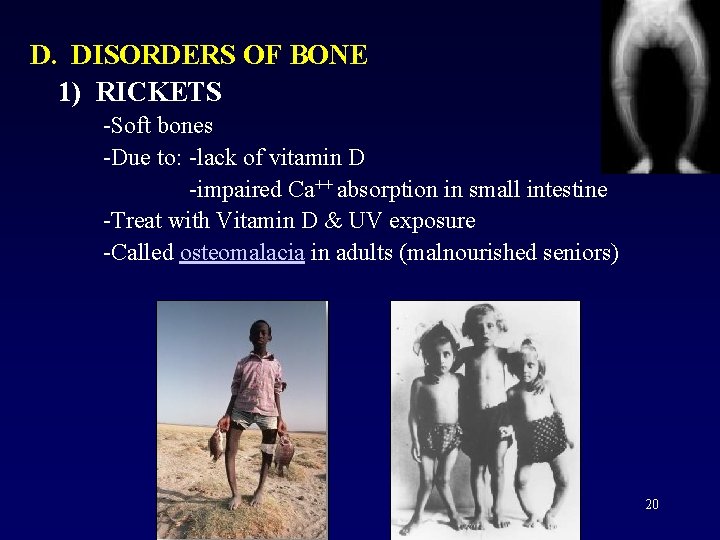 D. DISORDERS OF BONE 1) RICKETS -Soft bones -Due to: -lack of vitamin D