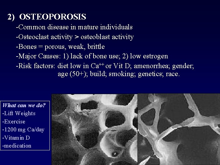 2) OSTEOPOROSIS -Common disease in mature individuals -Osteoclast activity > osteoblast activity -Bones =