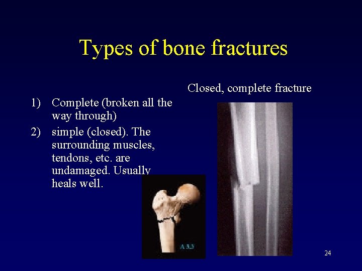 Types of bone fractures Closed, complete fracture 1) Complete (broken all the way through)