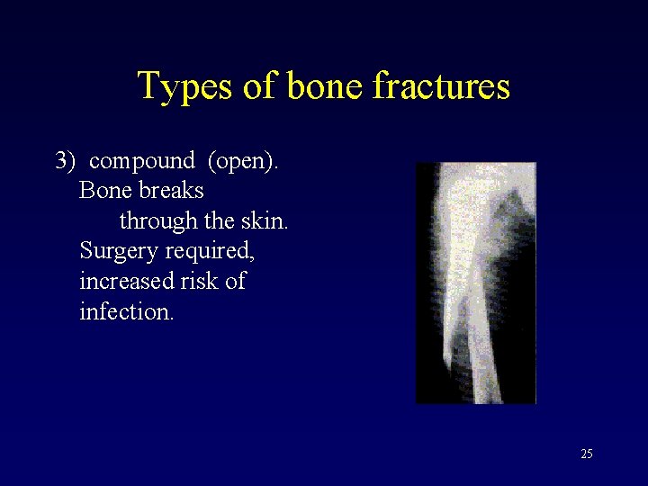 Types of bone fractures 3) compound (open). Bone breaks through the skin. Surgery required,