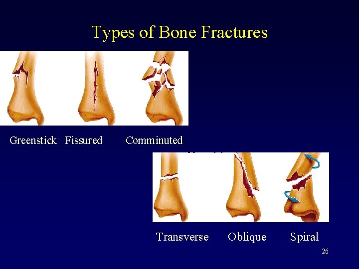 Types of Bone Fractures Greenstick Fissured Comminuted Transverse Oblique Spiral 26 