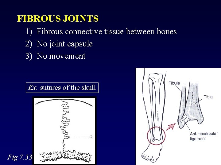 FIBROUS JOINTS 1) Fibrous connective tissue between bones 2) No joint capsule 3) No