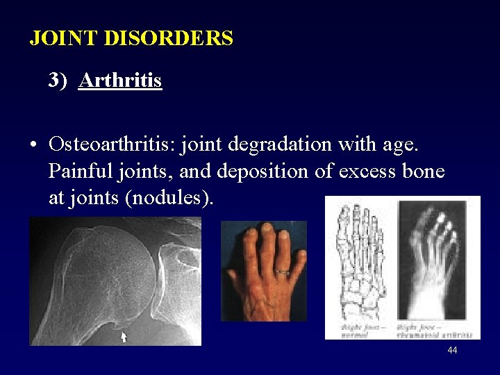 JOINT DISORDERS 3) Arthritis • Osteoarthritis: joint degradation with age. Painful joints, and deposition
