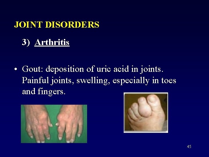 JOINT DISORDERS 3) Arthritis • Gout: deposition of uric acid in joints. Painful joints,