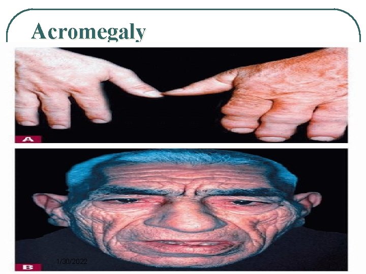 Acromegaly 1/30/2022 9 