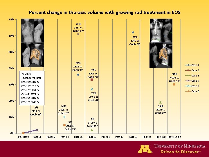 Percent change in thoracic volume with growing rod treatment in EOS 70% 61% 3357